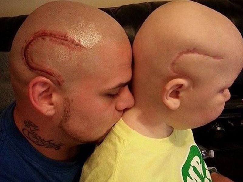 Un papa se tatoue la cicatrice de son fils opéré d'une tumeur au cerveau