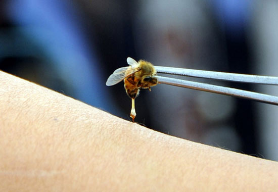 MTC : controverse autour de la thérapie au venin d'abeille