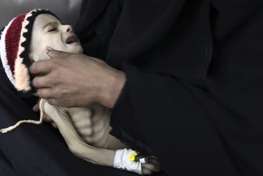 Le 28 mai 2012 dans un centre de thérapie alimentaire de Sanaa au Yémen, une femme porte dans ses bras sa fille souffrant de malnutrition. (REUTERS/Mohamed al-Sayaghi)