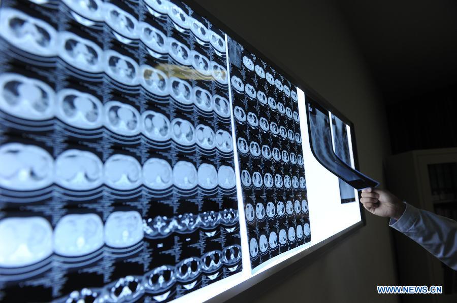 Un médecin examine les radios des poumons d'un patient infecté par le virus de la grippe aviaire H7N9, à l'Hôpital du Peuple de Bozhou, dans la province orientale de l'Anhui, le 8 avril 2013. (Xinhua/Liu Junxi)