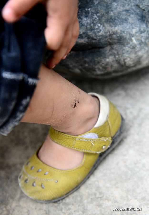 La petite Du Xinrui âgée de 4 ans montre une blessure à la cheville qu'elle s'est faite durant le tremblement de terre survenu le 20 avril 2013 dans le comté de Lushan dans la province chinoise du Sichuan. (Photo : Xinhua/Zhang Hongxiang)