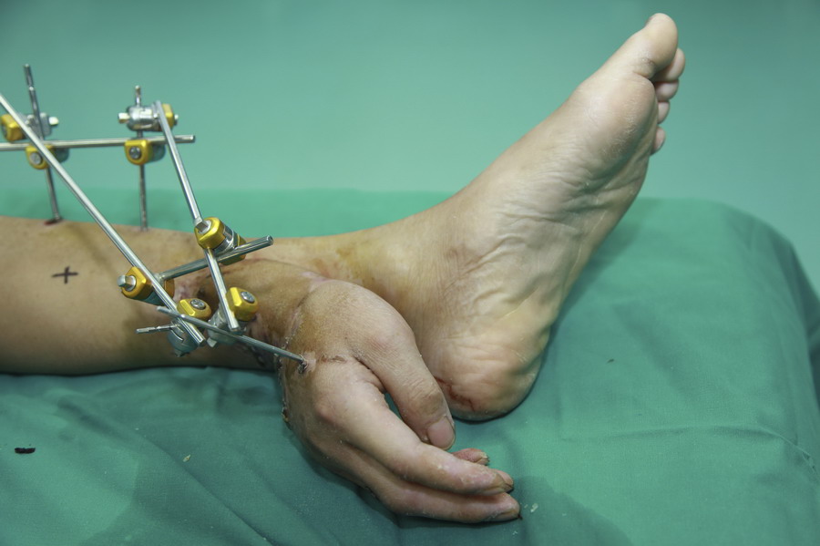 La main droite amputée de Xiao Wei a été greffée temporairement à sa cheville avant de subir une chirurgie pour replacer la main, à l'hôpital Xiangya à Changsha, la province du Hunan, le 4 décembre 2013 (document fourni par l'hôpital Xiangya, Central South University).