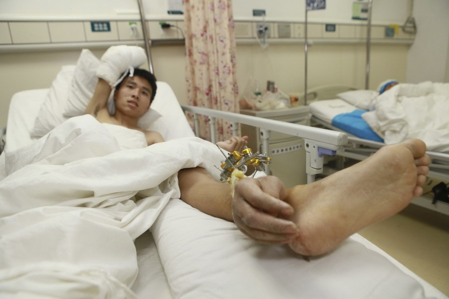 La main droite coupée de Xiao Wei a été greffée temporairement à sa cheville, avant de subir une chirurgie de rattachement à l'hôpital Xiangya à Changsha, la province du Hunan, le 4 décembre 2013 (document fourni par l'hôpital Xiangya, Central South University).